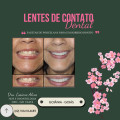 facetas-porcelana-goiania-goias